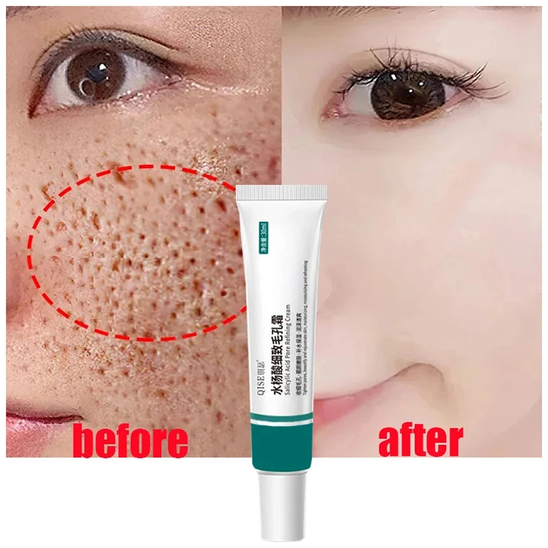 Sérum à l'Acide Salicylique