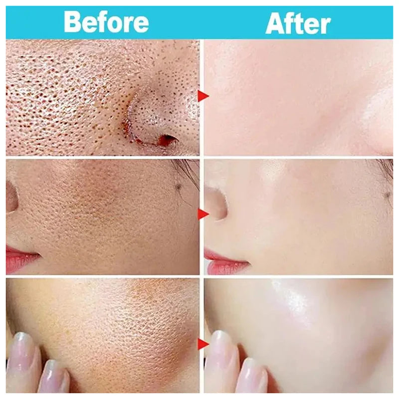 Sérum à l'Acide Salicylique