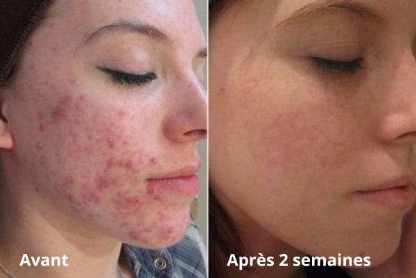 DermaWave | Nettoyage sonique avancé