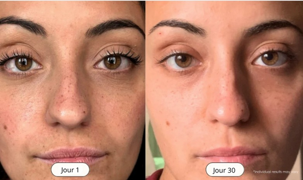 DermaVac™ – Soin d’extraction haute performance