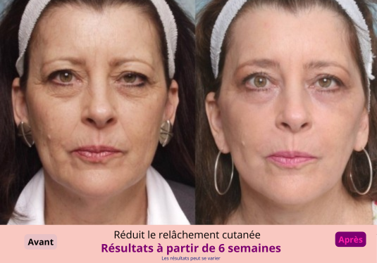 Liftéa – Appareil Liftant Visage + Sérum Anua Offert